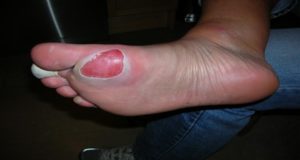 How-To-Get-Rid-Of-Foot-Blisters-In-No-Time-1