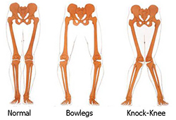 bowlegs-vs-knock-knees