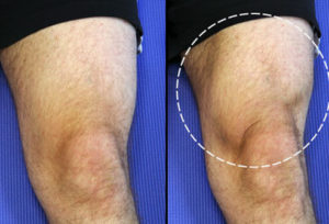 osteoarthritis-knee-exercises-s4-trainer-doing-quad-set