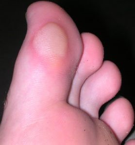 blister 1st toe