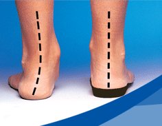 orthotics flat feet