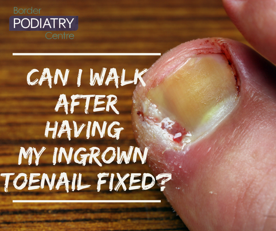 Is Surgery An Option For My Ingrown Toenail? – Border Podiatry Centre